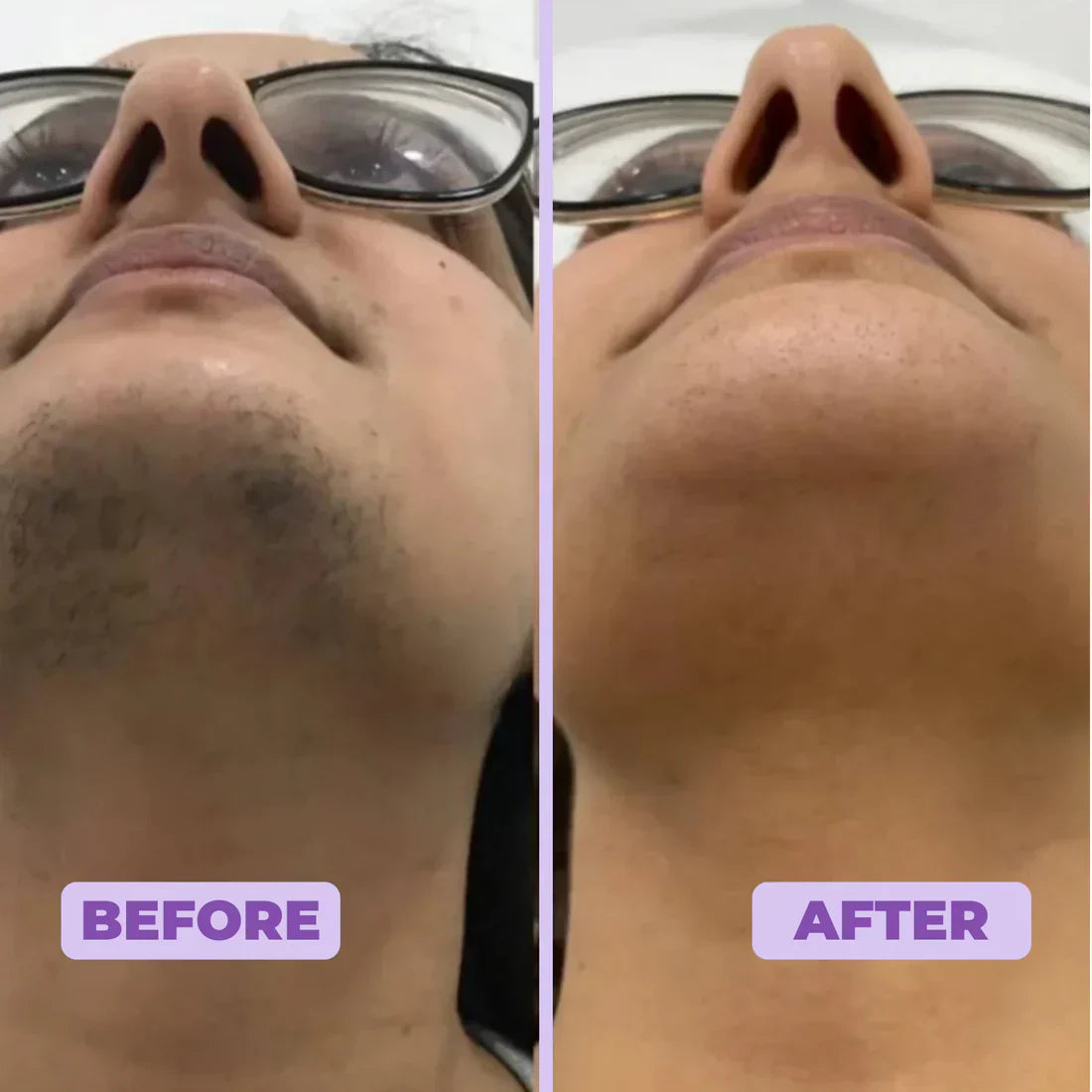 Facial Hair Removal Cream | 1+1 FREE